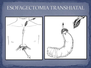 Carcinoma de la union gastroesogafica | PPTX