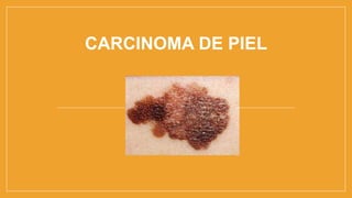 CARCINOMA DE PIEL
 
