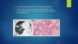  Se desarrolla exclusivamente en las paredes alveolares.
 Además hay presencia de esputo con abundante mucina
(broncorrea), el cual es un signo característico de Carcinoma
bronquioalveolar.
 