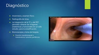 Diagnóstico
 Anamnesis y examen físico.
 Radiografía de tórax.
 La integración de la TC y del PET
permiten obtener las imágenes
anatómicas y funcionales en un solo
estudio, para la estadificación.
 Broncoscopia y toma de biopsia.
 Punción transbronquial o
transtorácica: tumores periféricos.
 
