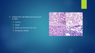  Clasificación del Adenocarcinoma por
la OMS:
 Acinoso
 Papilar
 Sólido con formación de moco
 Bronquiolo-alveolar
 