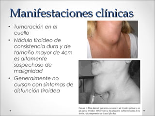 Manifestaciones clínicas
• Tumoración en el
  cuello
• Nódulo tiroideo de
  consistencia dura y de
  tamaño mayor de 4cm
  es altamente
  sospechoso de
  malignidad
• Generalmente no
  cursan con síntomas de
  disfunción tiroidea
 