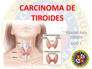 CARCINOMA DE
TIROIDES
Ubadah Kalo
100405
GOD 1
 
