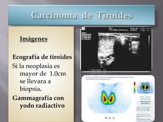 Imágenes
Ecografía de tiroides
Si la neoplasia es
mayor de 1.0cm
se llevara a
biopsia.
Gammagrafía con
yodo radiactivo
 
