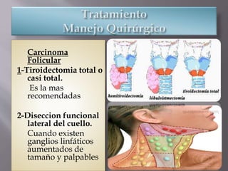 Carcinoma
Folicular
1-Tiroidectomia total o
casi total.
Es la mas
recomendadas
2-Diseccion funcional
lateral del cuello.
Cuando existen
ganglios linfáticos
aumentados de
tamaño y palpables
 