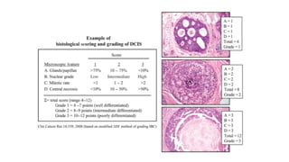 Presentación del carcinoma ductal in situ con generalidades | PPTX