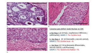 Presentación del carcinoma ductal in situ con generalidades | PPTX