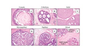 Carcinoma Ductal In Situ con generalidades en oncología | PPTX