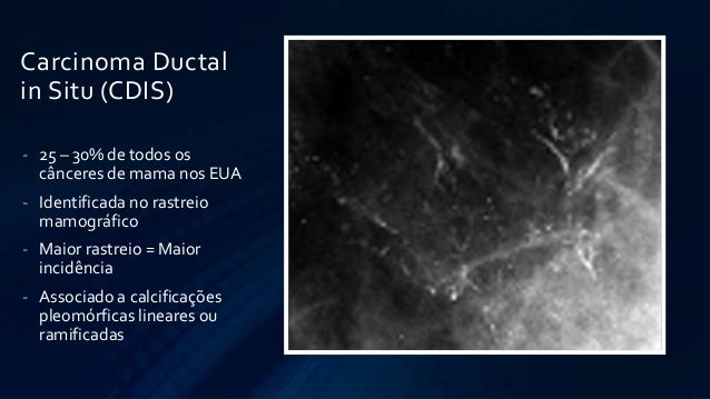 tratamento pregnancy carcinoma ductal into situ