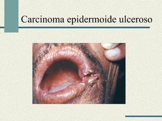 Carcinoma epidermoide ulceroso 
 