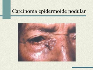 Carcinoma epidermoide nodular 
 