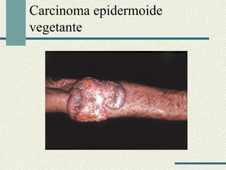 Carcinoma epidermoide 
vegetante 
 