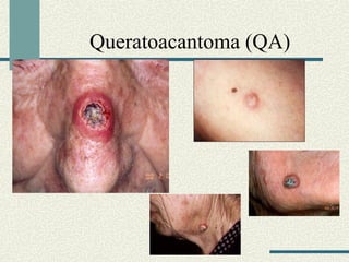 Queratoacantoma (QA) 
 