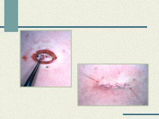 Carcinoma epidermoide