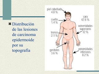 Distribución 
de las lesiones 
de carcinoma 
epidermoide 
por su 
topografía 
 