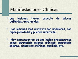 Manifestaciones Clínicas 
 Las lesiones ttiieenneenn aassppeeccttoo ddee ‘‘ppllaaccaass 
ddeeffiinniiddaass,, eennrroojjeecciiddaass.. 
 LLaass lleessiioonneess mmaass iinnvvaassiivvaass ssoonn nnoodduullaarreess,, ccoonn 
hhiippeerrqquueerraattoossiiss yy ppuueeddeenn uullcceerraarrssee.. 
 HHaayy aanntteecceeddeenntteess ddee uunnaa lleessiióónn pprreeccaanncceerroossaa 
ccoommoo:: ddeerrmmaattiittiiss ssoollaarreess ccrróónniiccaass,, qquueerraattoossiiss 
ssoollaarreess,, cciiccaattrriicceess ccrróónniiccaass,, qquueeiilliittiiss,, eettcc.. 
 