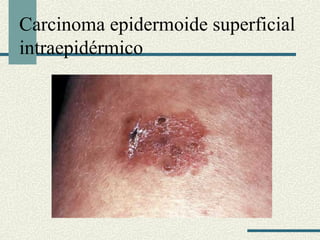 Carcinoma epidermoide superficial 
Գٰ辱é 
 