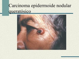 Carcinoma epidermoide nodular 
ܱó 
 