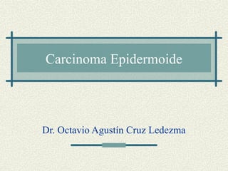Carcinoma Epidermoide 
Dr. Octavio Agustín Cruz Ledezma 
 