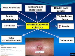 MANIFESTACIONES
CLÍNICAS
Pápula/placa
queratósica
Bordes poco
nítidos
Síntomático Tamaño
Induración
Color
carne/eritematoso
Areas de fotodaño
Típico lesión
única
Lesión
precursora
RBB
 