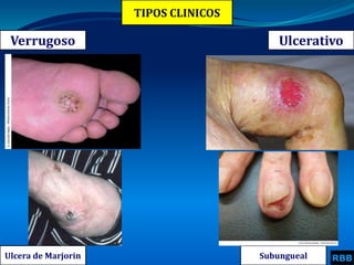TIPOS CLINICOS
Verrugoso
RBB
Ulcerativo
Ulcera de Marjorin Subungueal
 