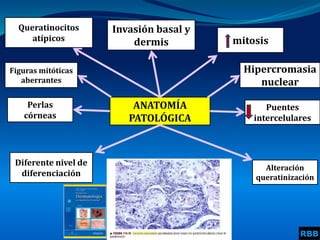 ANATOMÍA
PATOLÓGICA
Invasión basal y
dermis mitosis
Perlas
córneas
Puentes
intercelulares
Alteración
queratinización
Diferente nivel de
diferenciación
Queratinocitos
atípicos
Hipercromasia
nuclear
Figuras mitóticas
aberrantes
RBB
 