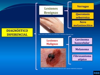 DIAGNÓSTICO
DIFERENCIAL
Lesiones
Benignas
Verrugas
Melanoma
Lesiones
Malignas
Queratosis
seborreica
Carcinoma
basocelular
RBB
Nevo
melaninocítico
Fibroxantoma
atípico
https://www.eistria.com/en/melanoma-skin-cancer-treatment-prognosis
https://www.news-medical.net/health/Wart-Treatments-(Spanish).aspx
 