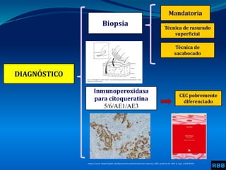 DIAGNÓSTICO
Biopsia
Mandatoria
Inmunoperoxidasa
para citoqueratina
5/6/AE1/AE3
Técnica de rasurado
superficial
RBB
CEC pobremente
diferenciado
https://www.researchgate.net/figure/Immunohistochemical-staining-100x-positive-for-CK5-6_fig3_232976459
Técnica de
sacabocado
 
