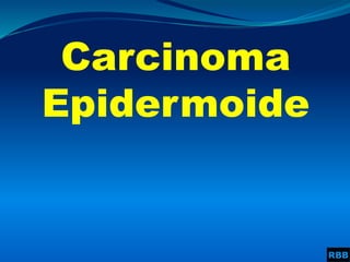Carcinoma
Epidermoide
RBB
 