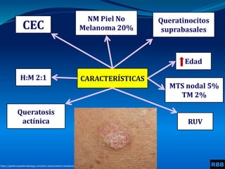 CARACTERÍSTICAS
CEC
NM Piel No
Melanoma 20%
Queratinocitos
suprabasales
H:M 2:1
Edad
RUV
Queratosis
actínica
RBB
https://goldencoastdermatology.com/skin-cancer/actinic-keratosis/
MTS nodal 5%
TM 2%
 