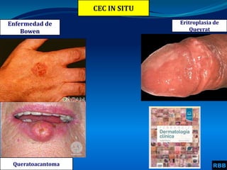 CEC IN SITU
Enfermedad de
Bowen
RBB
Eritroplasia de
Queyrat
Queratoacantoma
 