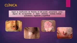 CLÍNICA
Según la clasificación de Peniche, el CEC puede presentarse como
alguno de los siguientes 5 tipos: Ulceroso, nodular, nodular
queratósico, vegetante y superficial
 