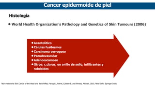 Cancer epidermoide de piel
Histología
• World Health Organization’s Pathology and Genetics of Skin Tumours (2006)
•Acantolítico
•Células fusiformes
•Carcinoma verrugoso
•Pseudovascular
•Adenoescamoso
•Otros: c.claras, en anillo de sello, infiltrantes y
rabdoides
Non-melanoma Skin Cancer of the Head and Neck Riffat, Faruque., Palme, Carsten E. and Veness, Michael. 2015. New Delhi: Springer India.
 