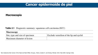 Cancer epidermoide de piel
Macroscopía
Non-melanoma Skin Cancer of the Head and Neck Riffat, Faruque., Palme, Carsten E. and Veness, Michael. 2015. New Delhi: Springer India.
 