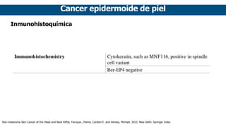 Cancer epidermoide de piel
Inmunohistoquímica
Non-melanoma Skin Cancer of the Head and Neck Riffat, Faruque., Palme, Carsten E. and Veness, Michael. 2015. New Delhi: Springer India.
 