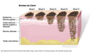 Cancer epidermoide de piel
Características de alto riesgo NMSC
Non-melanoma Skin Cancer of the Head and Neck Riffat, Faruque., Palme, Carsten E. and Veness, Michael. 2015. New Delhi: Springer India.
 