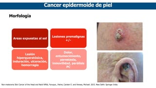 Cancer epidermoide de piel
Morfología
Areas expuestas al sol
Lesiones premalignas
+/-
Lesión
hiperqueratósica,
induración, ulceración,
hemorragia
Dolor,
entumecimiento,
parestesia,
inmovilidad, parálisis
PC
Non-melanoma Skin Cancer of the Head and Neck Riffat, Faruque., Palme, Carsten E. and Veness, Michael. 2015. New Delhi: Springer India.
 