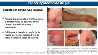 Cancer epidermoide de piel
Presentación clínica: CCE invasivo
• Pápula, placa o nódulo asintomático
o doloroso que se agranda con el
tiempo y puede ulcerarse o
necrosarse
• Infiltrarse e invadir a través de la
fascia, periostio, pericondrio y la
vaina neural en casos agresivos
Non-melanoma Skin Cancer of the Head and Neck Riffat, Faruque., Palme, Carsten E. and Veness, Michael. 2015. New Delhi: Springer India.
 