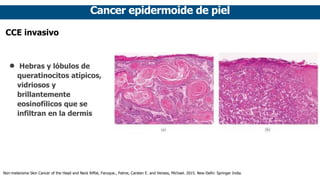 Cancer epidermoide de piel
CCE invasivo
• Hebras y lóbulos de
queratinocitos atípicos,
vidriosos y
brillantemente
eosinofílicos que se
infiltran en la dermis
Non-melanoma Skin Cancer of the Head and Neck Riffat, Faruque., Palme, Carsten E. and Veness, Michael. 2015. New Delhi: Springer India.
 