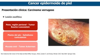Cancer epidermoide de piel
Presentación clínica: Carcinoma verrugoso
• Lesión exofítica
Pene, región perianal - Tumor
Buscke-Loewestein
Mucosa oral - Tumor Ackerman
Planta del pie - Epitelioma
cuniculatum
Non-melanoma Skin Cancer of the Head and Neck Riffat, Faruque., Palme, Carsten E. and Veness, Michael. 2015. New Delhi: Springer India.
 