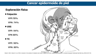 Cancer epidermoide de piel
Exploración física
• Palpación
VPP:78%
VPN: 74%
• USG
VPP: 94%
VPN 80%
• TC
VPP: 90%
VPN: 80%
Haberal I, Celik H, Göçmen H, et al. Which is important in the evaluation of metastatic lymph nodes in head and neck cancer: palpation, ultrasonography, or computed tomography? Otolaryngol Head Neck Surg. 2004;130:197–201.
 