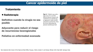 Cancer epidermoide de piel
Tratamiento
• Radioterapia
Definitivo cuando la cirugía no sea
posible
Adyuvante para reducir el riesgo
de recurrencias locoregionales
Paliativa en enfermedad avanzada
Non-melanoma Skin Cancer of the Head and Neck Riffat, Faruque., Palme, Carsten E. and Veness, Michael. 2015. New Delhi: Springer India.
 