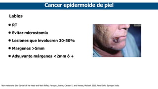 Cancer epidermoide de piel
Labios
• RT
• Evitar microstomía
• Lesiones que involucren 30-50%
• Margenes >5mm
• Adyuvante márgenes <2mm ó +
Non-melanoma Skin Cancer of the Head and Neck Riffat, Faruque., Palme, Carsten E. and Veness, Michael. 2015. New Delhi: Springer India.
 