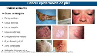 Cancer epidermoide de piel
Heridas crónicas
• Úlcera de Marjolin
• Poroqueratosis
• Lupus discoide
• Lupus vulgaris
• Liquen escleroso
• Linfogranuloma venero
• Granuloma inguinal
• Acne conglobata
• Hidroadenitis supuratica
Non-melanoma Skin Cancer of the Head and Neck Riffat, Faruque., Palme, Carsten E. and Veness, Michael. 2015. New Delhi: Springer India.
 