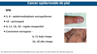 Cancer epidermoide de piel
VPH
• 5, 8 - epidermodisplasia verruguiforme
• 16 - periungeal
• 6, 11, 16, 18 - región anogenital
• Carcinoma verrugoso -
6, 11 bajo riesgo
16, 18 alto riesgo
Non-melanoma Skin Cancer of the Head and Neck Riffat, Faruque., Palme, Carsten E. and Veness, Michael. 2015. New Delhi: Springer India.
 