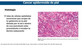 Cancer epidermoide de piel
Histología
• Islas de células epiteliales
escamosas que surgen de
la epidermis en la piel
dañada por el sol o dentro
de una queratosis solar
preexistente e invaden la
dermis subyacente
Non-melanoma Skin Cancer of the Head and Neck Riffat, Faruque., Palme, Carsten E. and Veness, Michael. 2015. New Delhi: Springer India.
 