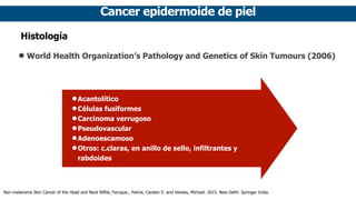 Cancer epidermoide de piel
Histología
• World Health Organization’s Pathology and Genetics of Skin Tumours (2006)
•Acantol...