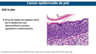 Cancer epidermoide de piel
CCE in situ
• Área de atipia de espesor total
de la epidermis con
pleomorfismo nuclear,
apoptos...