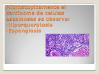 Microscopicamente el carcinoma de celulas escamosas se observa:-Hiperqueratosis-Espongiosis