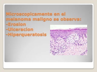 Microscopicamente en el melanoma maligno se observa:-Erosion-Ulceracion-Hiperqueratosis